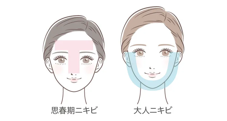 思春期ニキビ・大人ニキビ