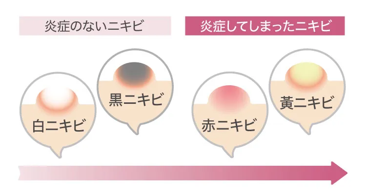 ニキビの種類