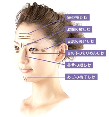 ボトックス注射対象部位