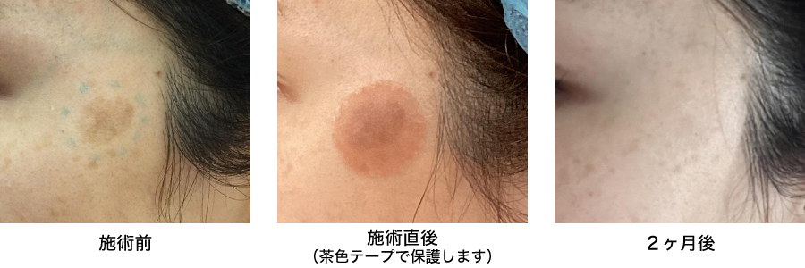 ピコスポット症例写真