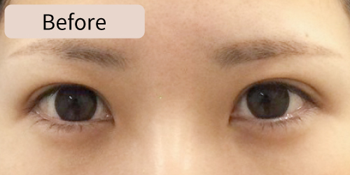 埋没法症例before