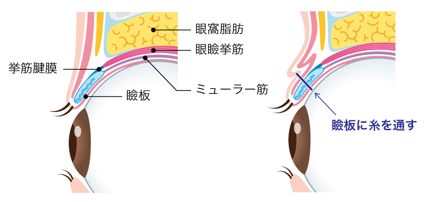 瞼板法