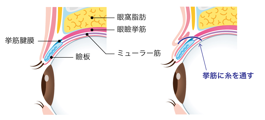 挙筋法