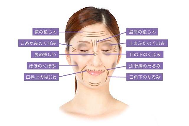 ヒアルロン酸注射対象部位