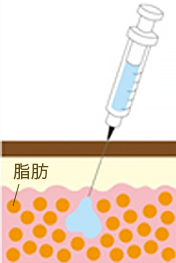 脂肪溶解注射の流れ1