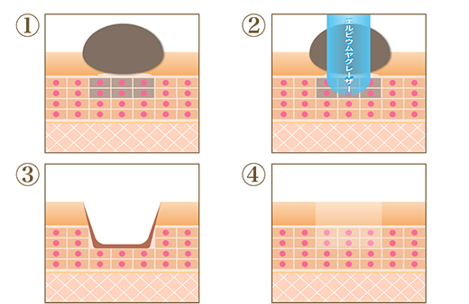 レーザーによるほくろ・イボ除去の治療イメージ
