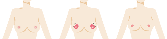 乳房挙上手術 軽度・中度の場合