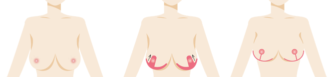 乳房挙上手術 重度の場合
