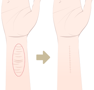 傷跡修正（切除術）