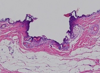 表皮が蒸散された皮膚組織