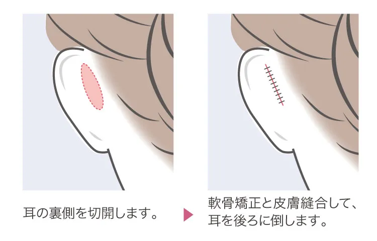 立ち耳形成の治療方法