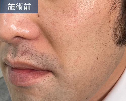 照射前