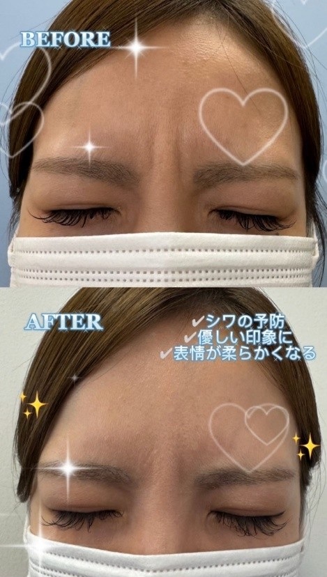 眉間ボトックス症例写真