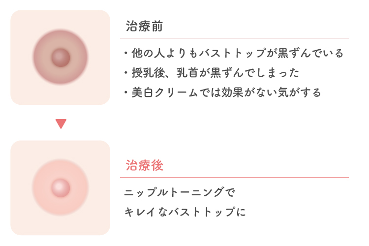 ニップルトーニング